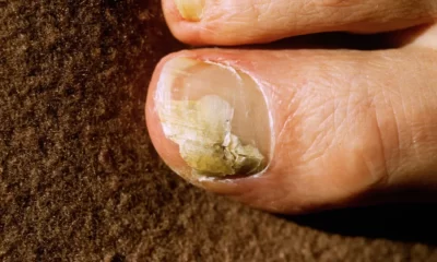 How Long Does It Take For Vicks To Work On Nail Fungus